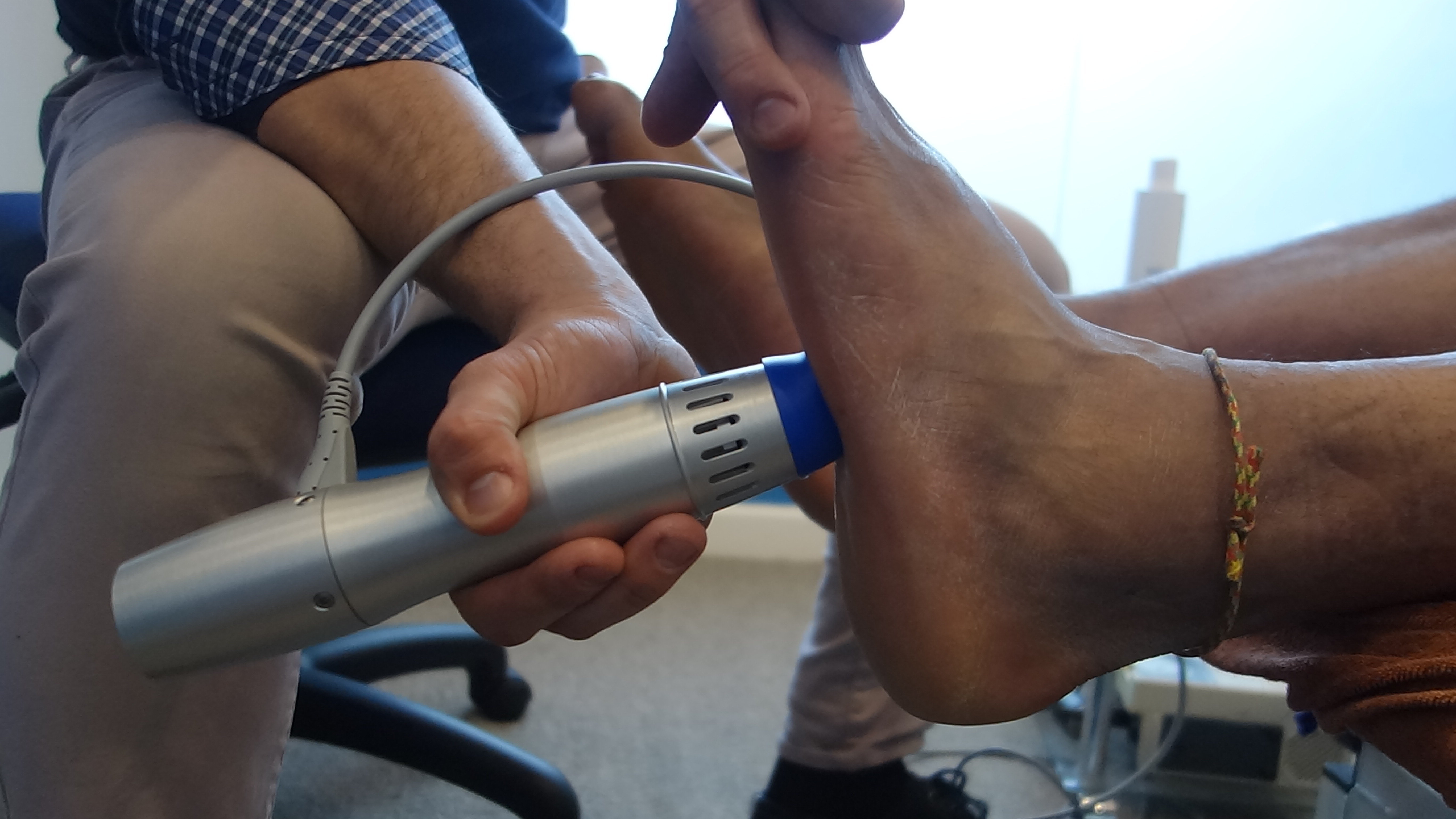 plantar fasciitis shock wave therapy nhs