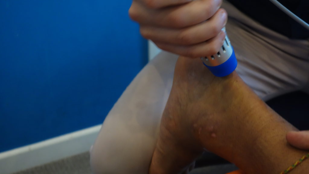 Shockwave Therapy Brighton | Achilles Tendonitis