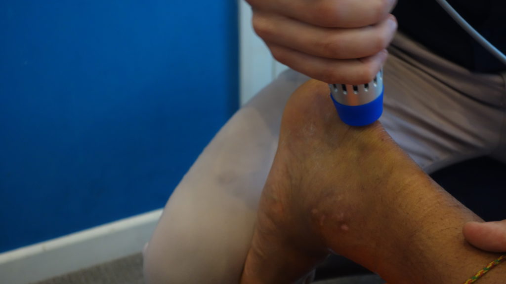 Shockwave Therapy | Achilles Tendonitis
