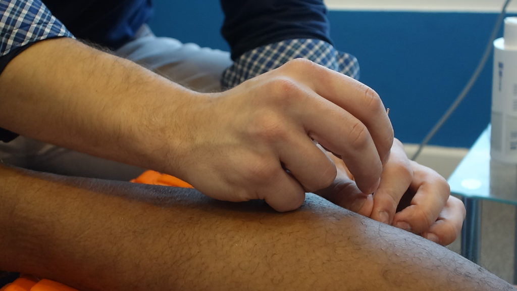 Acupuncture